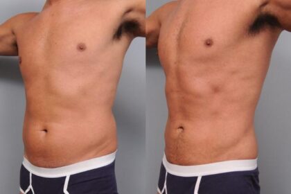 liposuction-options-and-costs:-what-you-need-to-know